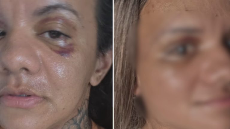 Veja como ficou o rosto da mulher que levou 61 socos do marido após passar por uma reconstrução facial.