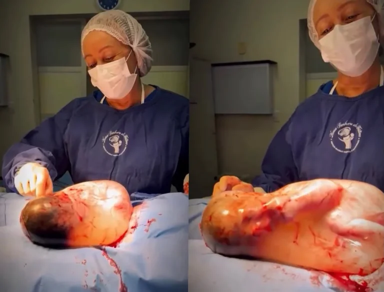 Bebê nasce ainda dentro da bolsa amniótica e momento emociona equipe de hospital em Sorriso; veja vídeo